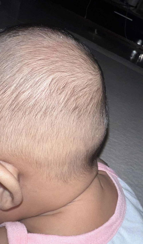 Will this flat spot round out with increased tummy time and reduced time on her head?