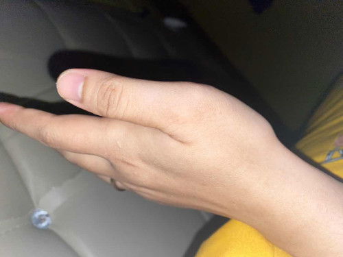 Ada yg sama gk? Pergelangan tangan sakit kayak Uratnya kejepit pertama yg kiri trs yg kanan