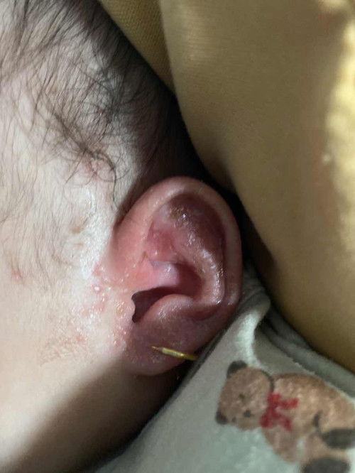 Daun telinga bayi merah , berair dan bau