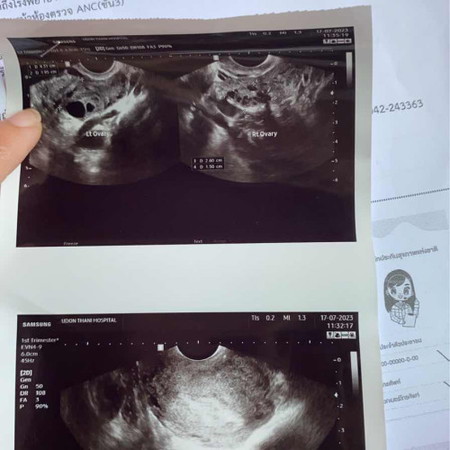 แม่ๆ ซาวน์น่องเจอตอนไหนกันค่ะ
บ้านนี้ ประจำเดือนล่าสุด5มิถุนายน
ถ้านับก็คง6วีคแต่พอไปฝากท้อง ไปซาวน์
ยังไม่เจอน้องเลยค่ะ 😔😔😔