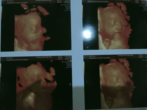 Plasenta ankreta atau sisa lengket.