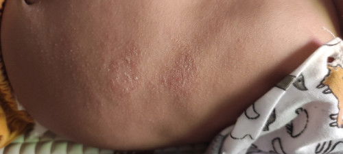 Kulit bayi memerah/gatal