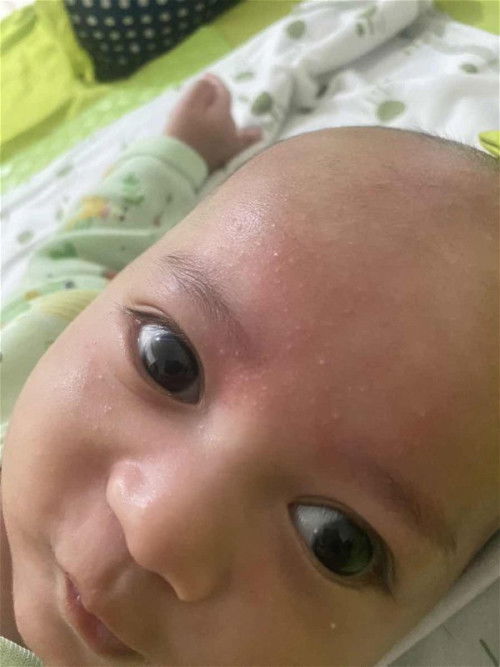 beruntusan pada wajah baby