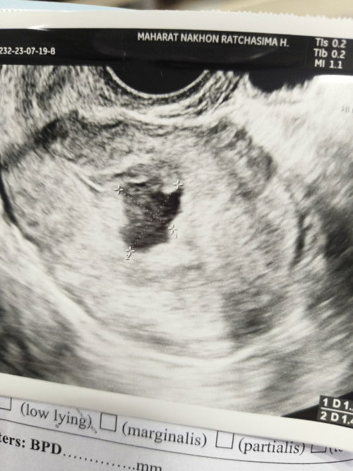 ถุงตั้งครรภ์ผิดรูปไม่เจอตัวอ่อน 8W5d