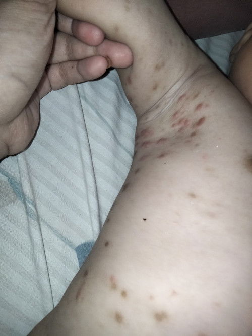 Gatal pada kulit bayi