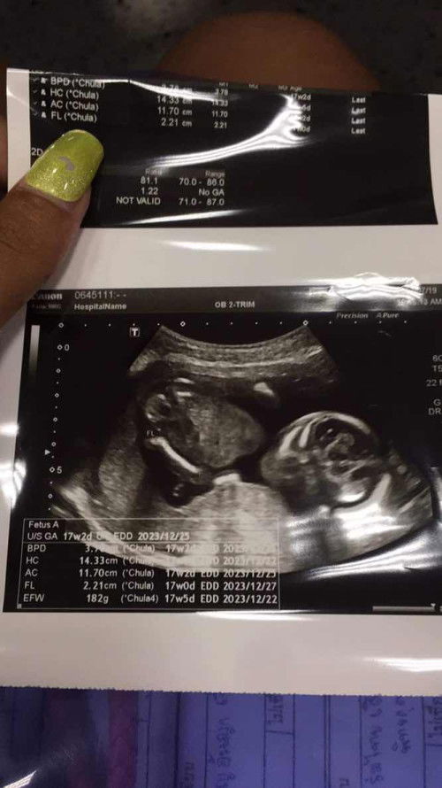 ท้องสองน้ำหนักลดลงท้องแรกน้ำหนักขึ้น