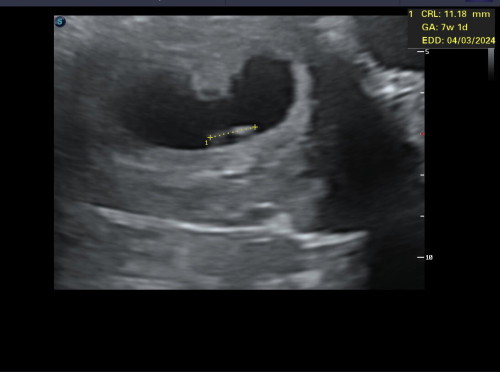 Scan 8weeks, dah nampak heartbeat. Normal tak scan janin usia 8weeks mcm ni?
