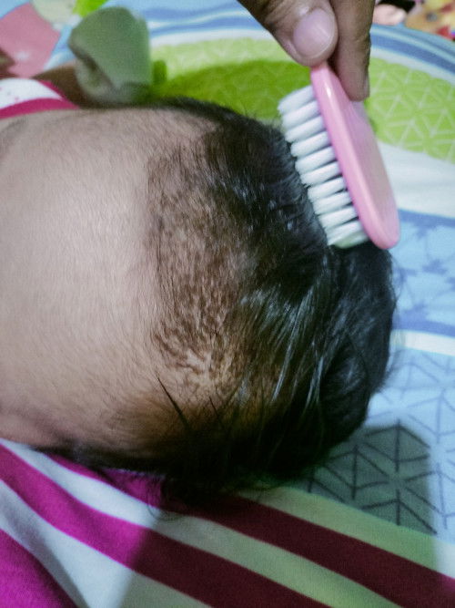 Cradle cap ba to mga mi?