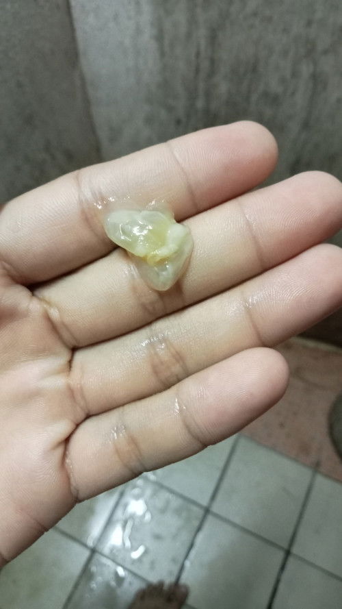 ขอสอบถาม มูกใส ไหลออกมาเป็น เหมือนเมือก