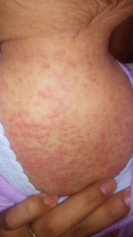 Bintik bintik merah banyak