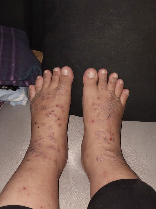 Kaki bengkak dan gatal2