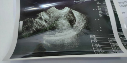 Positive sa PT pero wala po makita sa Ultrasound na baby. 4weeks.
naexperience nyu na po ba to?