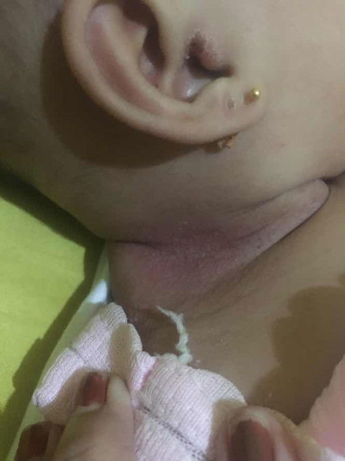 Biang keringet/cacar