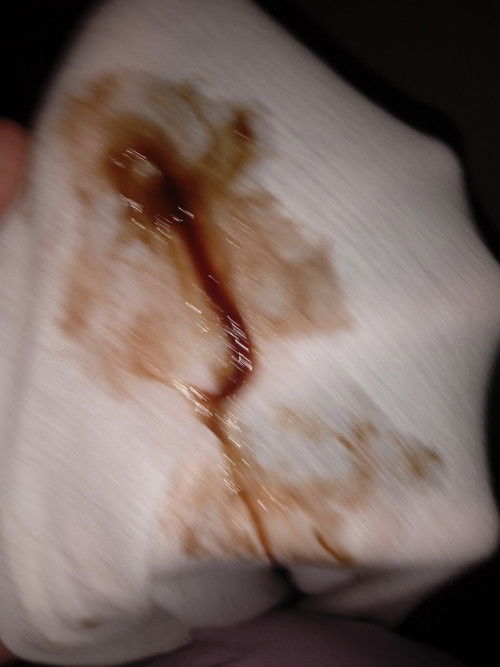 มีมูกเลือด