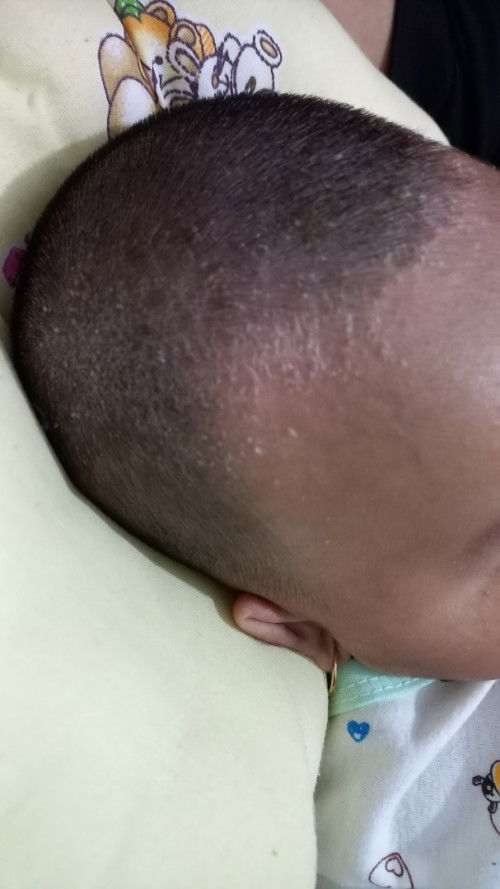 Cara bersihkan Cradle cap di ubun2 bayi