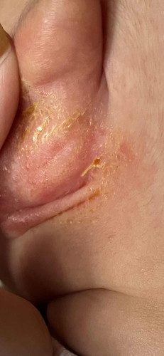 Yellow pus behind the ear