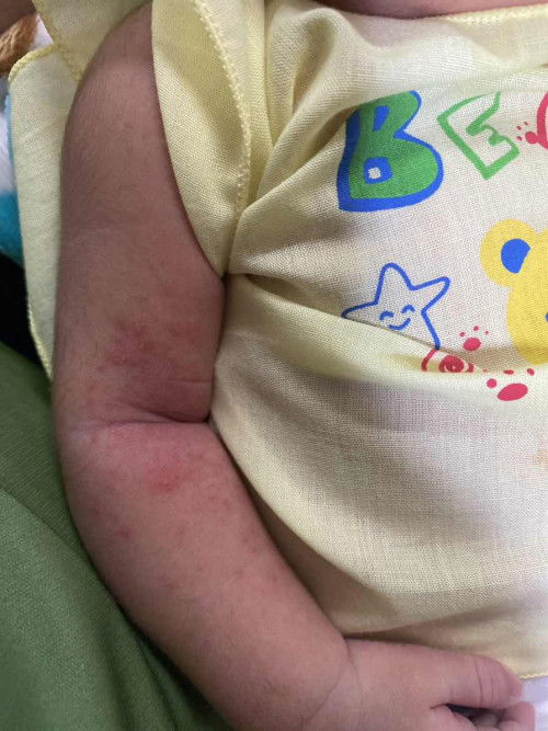 ผื่นแดงแบบนี้น้องเป็นอะไรคะ