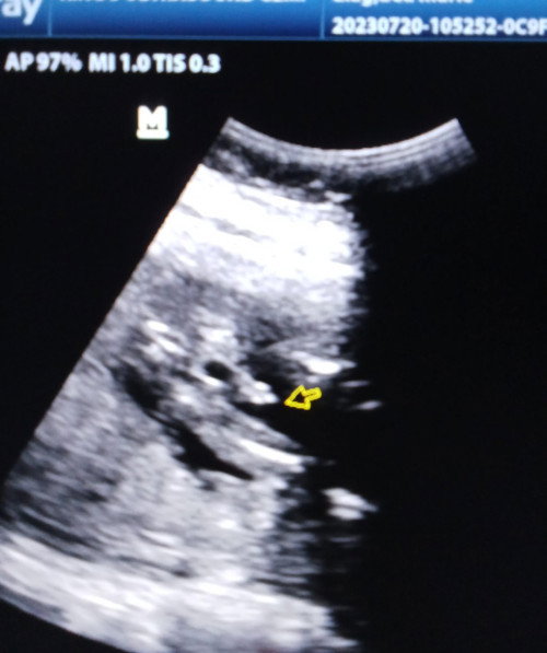 GENDER AT 18 WEEKS