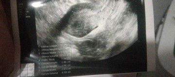 Ano ibigsabihin ng endo thick sa ultrasound