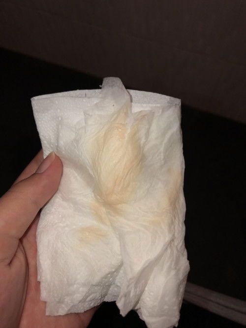 39w แบบนี้คือเป็นตกขาวหรืออะไรคะ