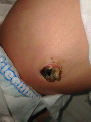 Infected umbilical cord