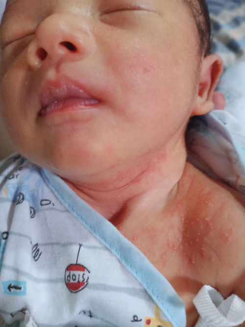 ลูกมีผื่นแดง