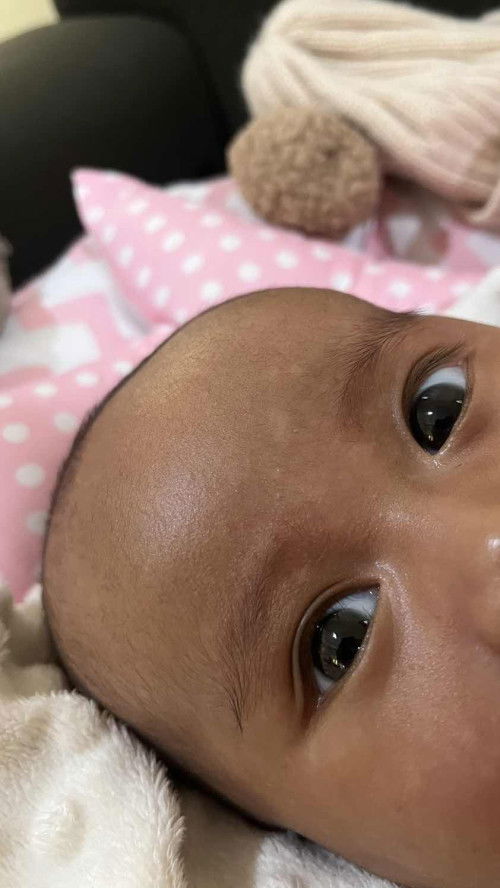 Bercak putih di wajah bayi 2bln