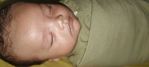 Beruntusan seluruh tubuh kaya keriput