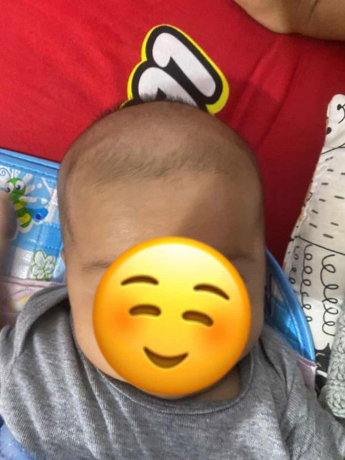 Jidat bergaris dan menonjol