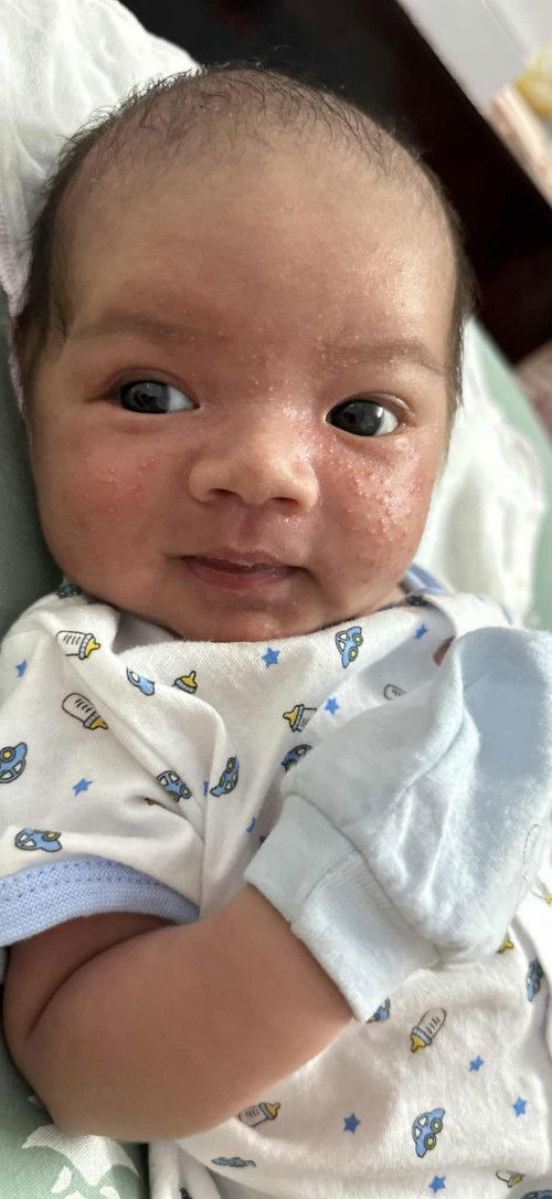 Chàm sữa ở trẻ sơ sinh