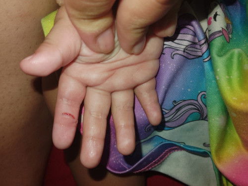 How to heal a baby finger cut of a 1 year old baby