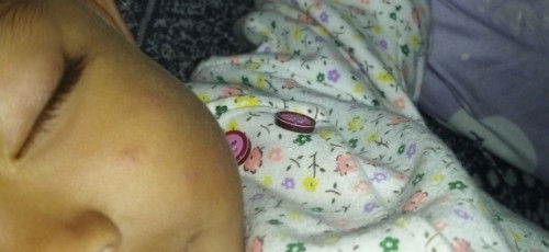 Ruam Merah Di Pipi Bayi