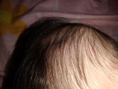 Kepala bayi penyok terjatuh