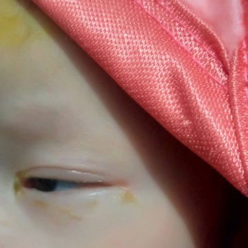 Bun ad kh yg anaknya keluar belek trs seperti ini ? Klo ad pnglaman obatnh ap y