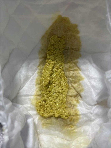 ลูก2เดือน22วันถ่ายแบบนี้กินนมผงล้วน