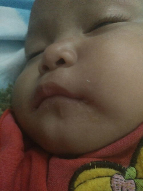 sudut bibir melepuh dan kering bayi 8 bulan