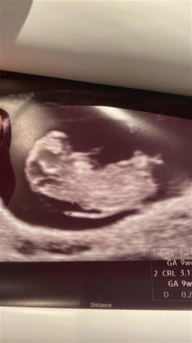 9wk6d ultrasound shows relatively high NT