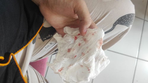 Sering mimisan selama tm 2