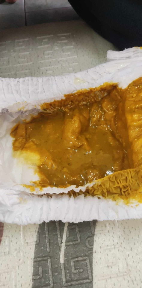 อึแบบนี้ผิดปกติ ไหม