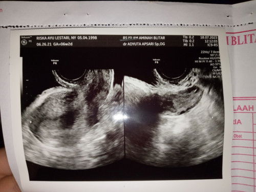 Masih penebalan dinding rahim