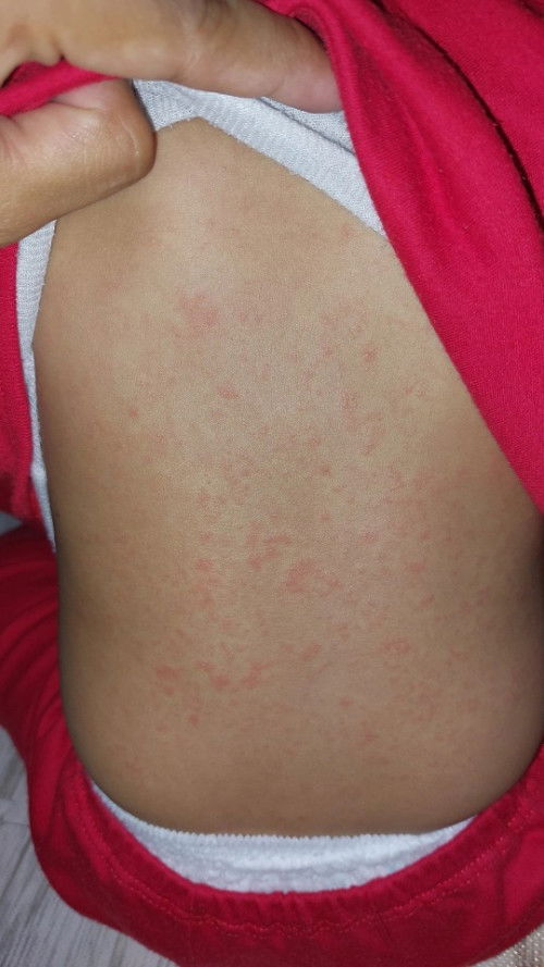 Campak atau biang keringat ini?