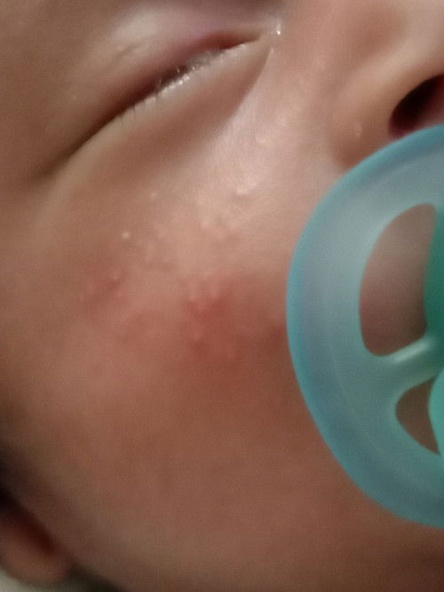 Sye nak tnyer...dekt pipi Anak Sye Ada bintik², tu ruam ke alahan Susu yea?