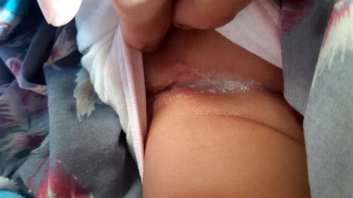 Membersihkan sisa salep ruam