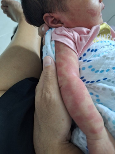 Rashes on my baby all over the body