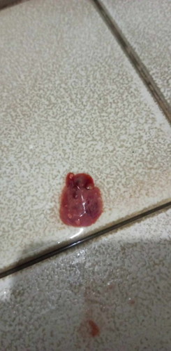 Sa mga nagka miscarriage po dyan ano po kaya to?