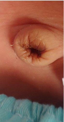 umbilical cord