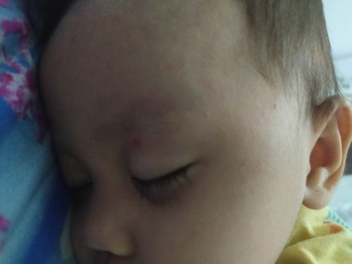 anak sering garuk kepala dan mata sampe berdarah