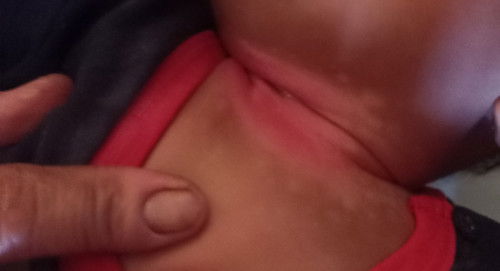 Leher bayi lecet parah