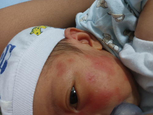 Baby rashes