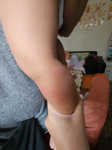 Kagat ng Insekto